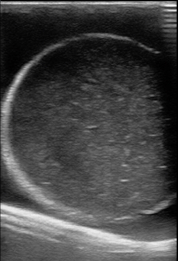 Figure 11 normal testicle model with hydrocele.jpg