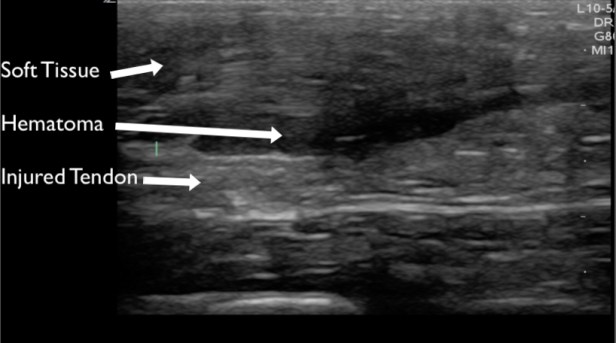 Figure 12 - achilles partial rupture labeled copy.jpg