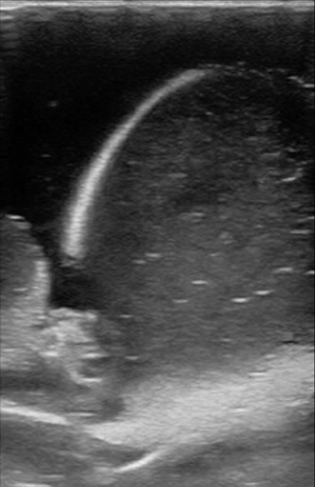 Figure 12 testicle normal with epididmyus hydrocele model.jpg