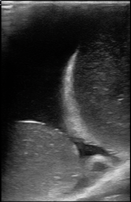 Figure 13 normal testicle, large epididymus, epididyma cyst vs epididymal tail hydrocele model.jpg