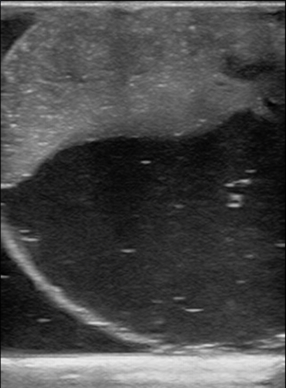 Figure 14 testicle infarction hydrocele model.jpg