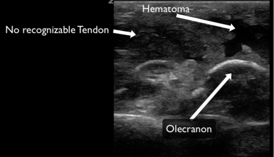 Figure 14 - Triceps tendon rupture copy.jpg