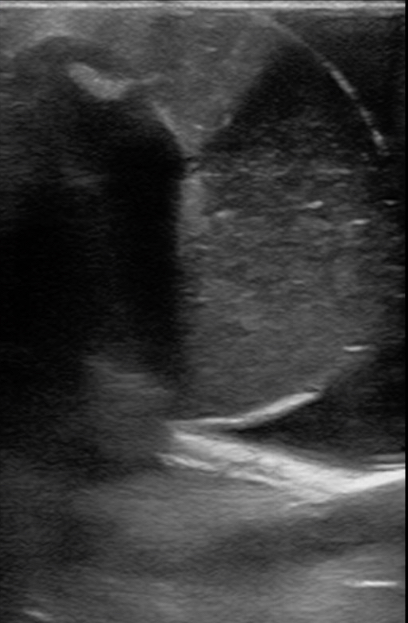 Figure 15 testicle infarction or rupture with FB, penetrating wound hematocele model.jpg