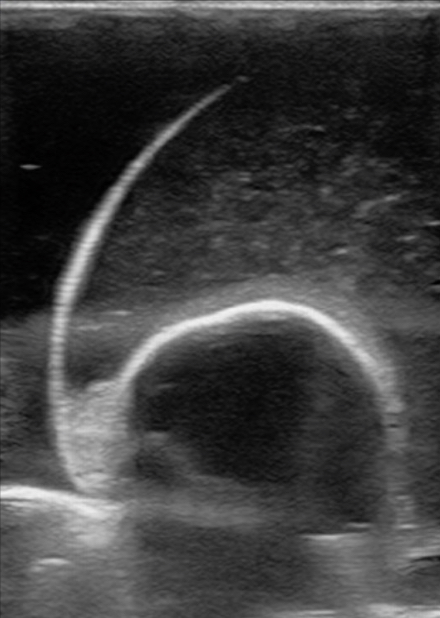 Figure 16 testicle with calcified mass or FB model.jpg