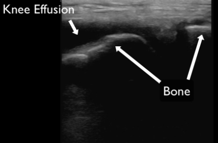 Figure 17 - knee effusion copy.jpg