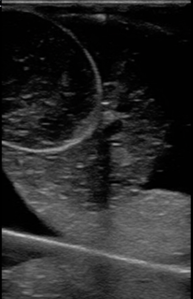 Figure 17 testicular rupture balloon within balloon hematocele mdoel.jpg