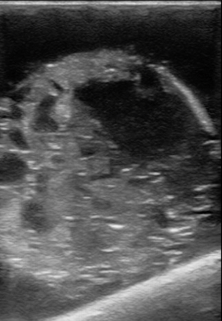 Figure 18 testicular rupture great, hematocele model.jpg
