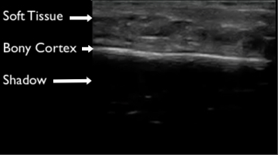Figure 2 - normal bone labeled copy.jpg