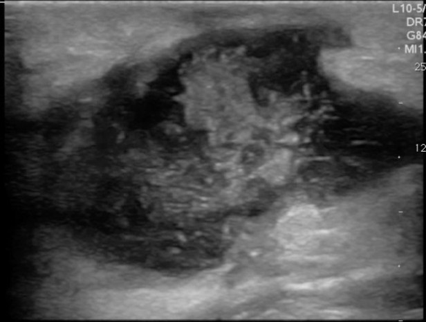 FIGURE 4 abscess 1 with debris copy.jpg