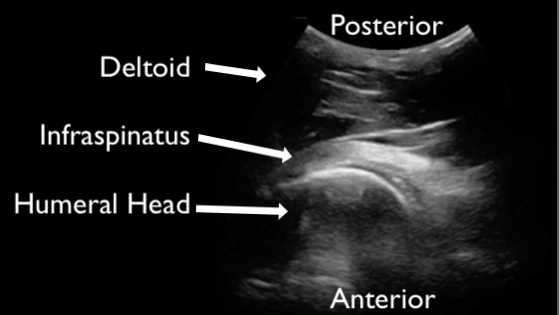 Figure 7 - normal shoulder labeled copy.jpg