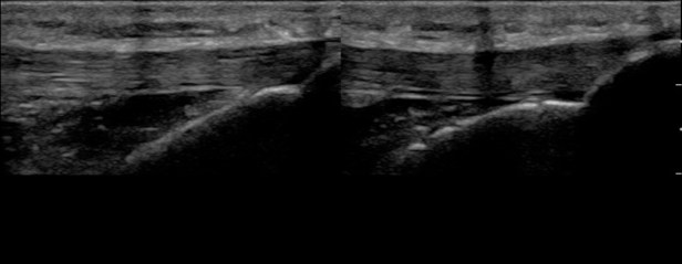 Figure 8 - Achilles tendon - normal split screen still.jpg