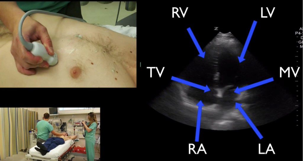 #POCUS #Cardiac #Anatomy in the apical 4 chamber view with probe ...