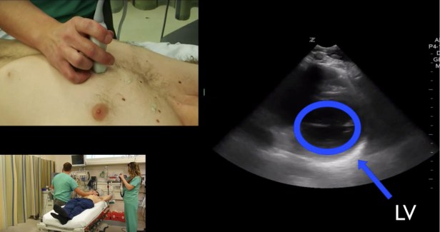 LV circle anatomy pss copy