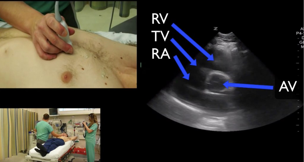 #POCUS #Cardiac #Anatomy in the parasternal short view with probe ...