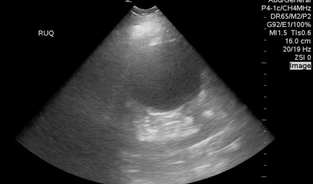 renal cyst fake out AAA copy