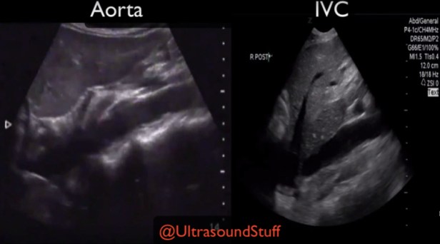 aorta vs IVC copy