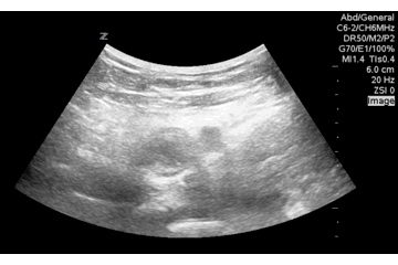 QA of the day over gained fem DVT