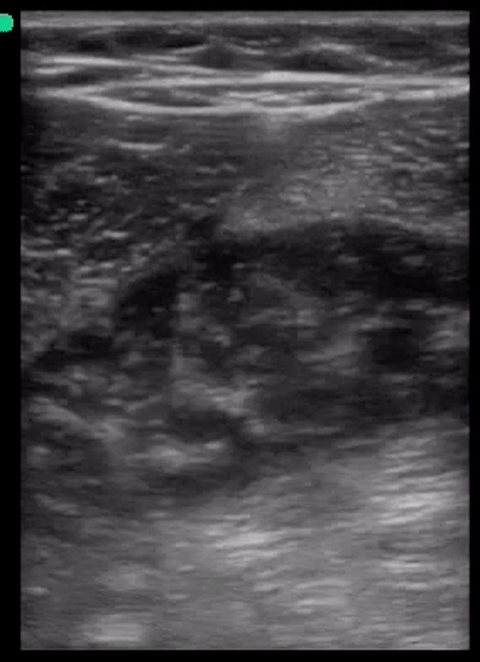 pyomyositis calf.gif