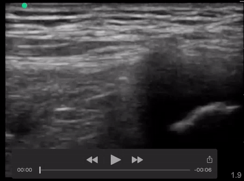 pyomyositis knee.gif