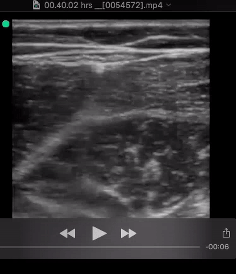 pyomyositis nml thigh short.gif