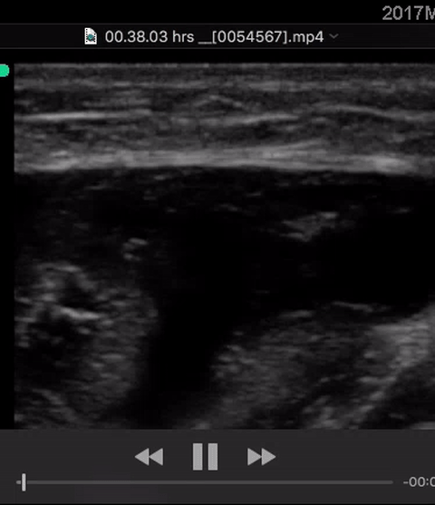 pyomyositis thigh short.gif