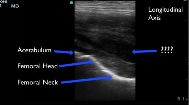 hip case anatomy with fluid collection copy