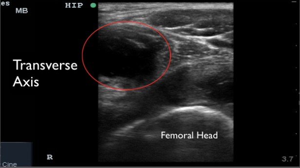 hip case collection in short axis copy