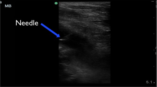 hip case needle aspiration copy